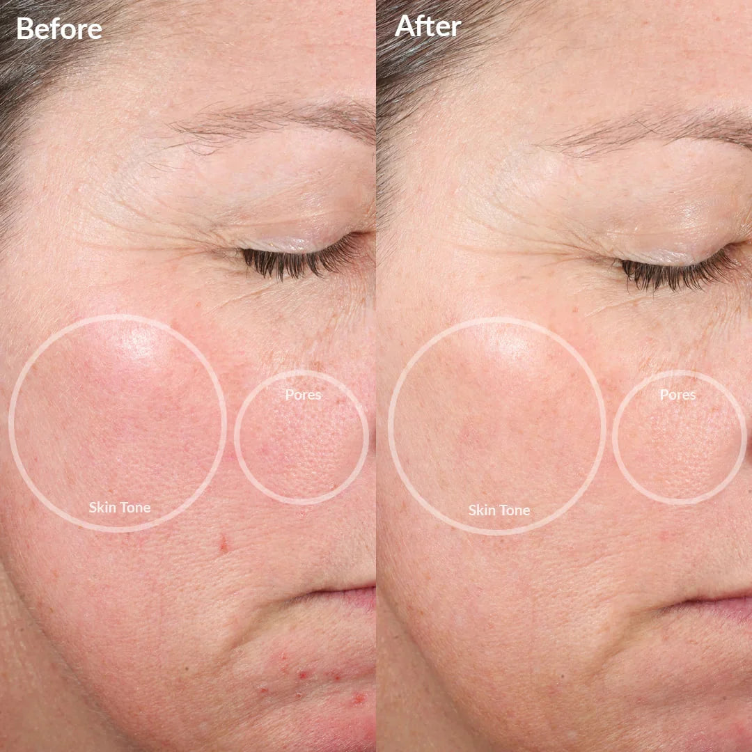 GlowZap™ Acne Spot Treatment
